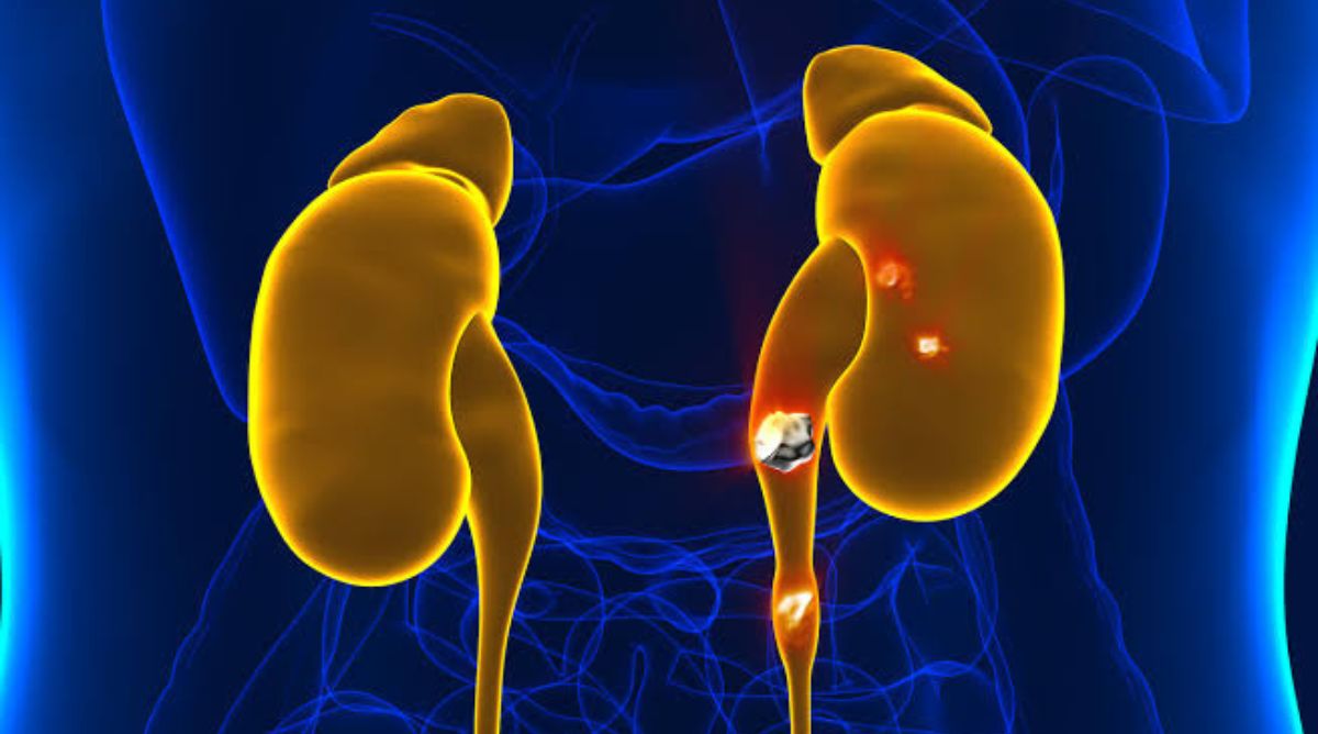 Can Kidney Stones Cause Constipation